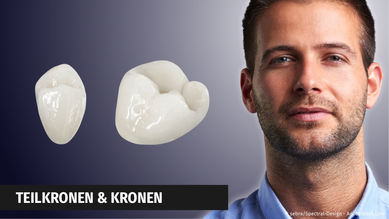 CEREC: Kronen und Teilkronen aus Keramik